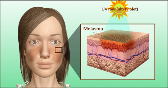 tratamento a laser para melasma 2