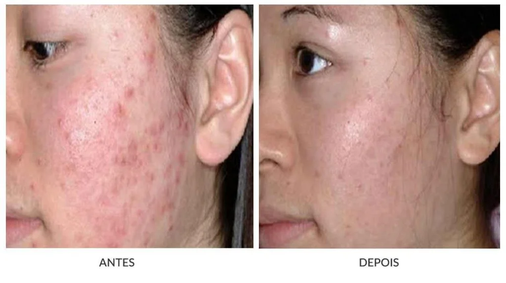 Duas imagens, a primeira, antes, mostra uma mulher com cicatriz de acne. A segunda, depois, uma mulher após o resultado do tratamento.