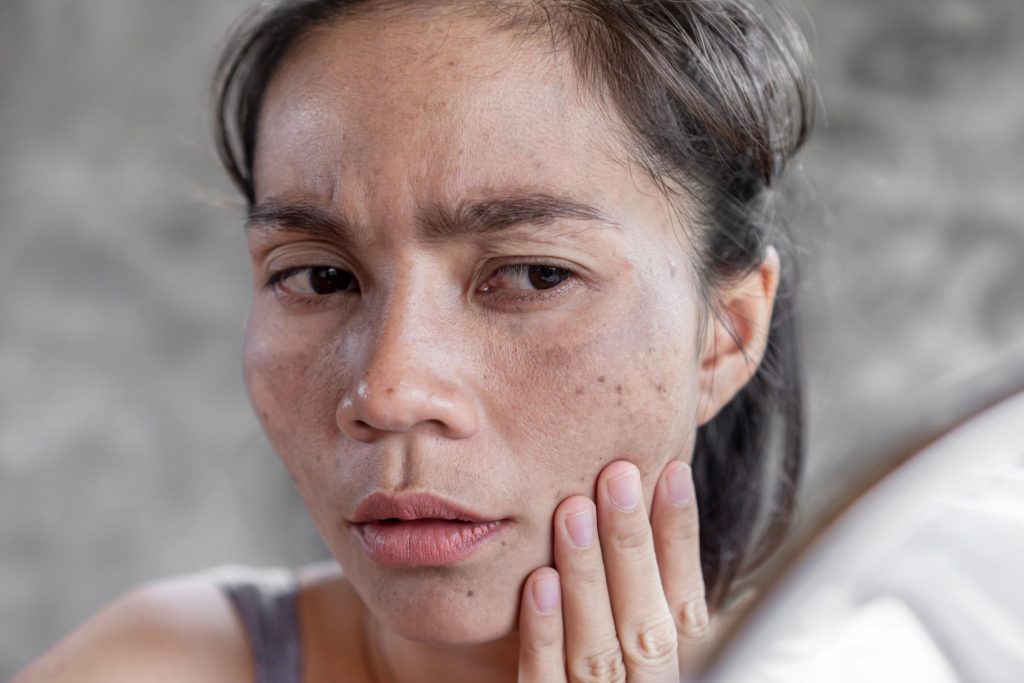 Xeroderma pigmentosum