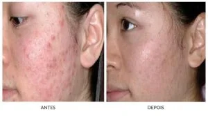 Duas imagens, a primeira, antes, mostra uma mulher com cicatrizes de acne. A segunda, depois, uma mulher após o resultado do tratamento.