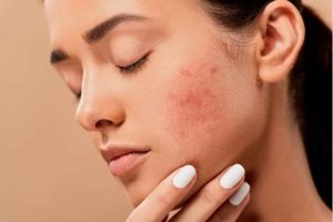 tratamento para cicatrizes de acne