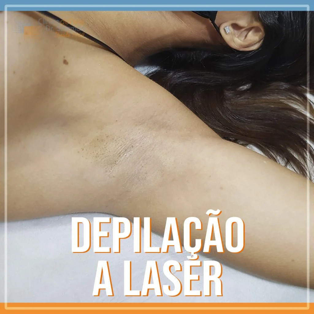 tratamento de depilação a laser