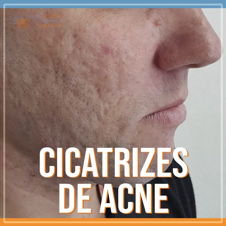 cicatrizes de acne