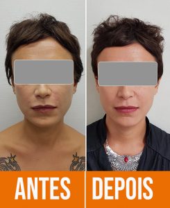 harmonização facial antes e depois