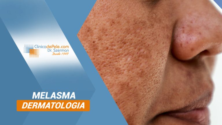 Clínica de Pele | Dermatologia, Laser & Estética | Tratamento para Melasma: veja os melhores!