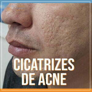 como tirar cicatrizes de acne