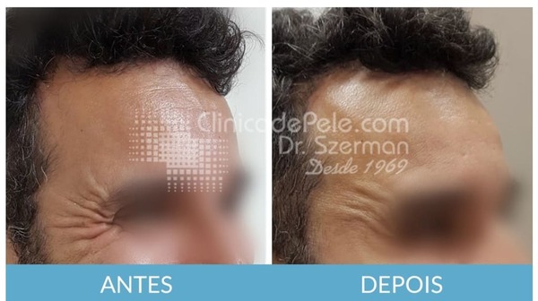 Tratamentos para Rejuvenescimento Facial antes e depois 1