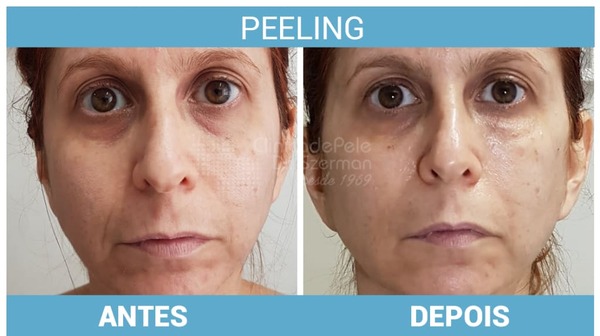   Tratamentos para Rejuvenescimento Facial antes e depois 