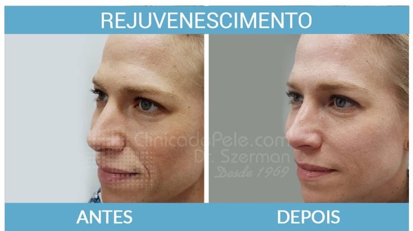 Tratamentos para Rejuvenescimento Facial antes e depois