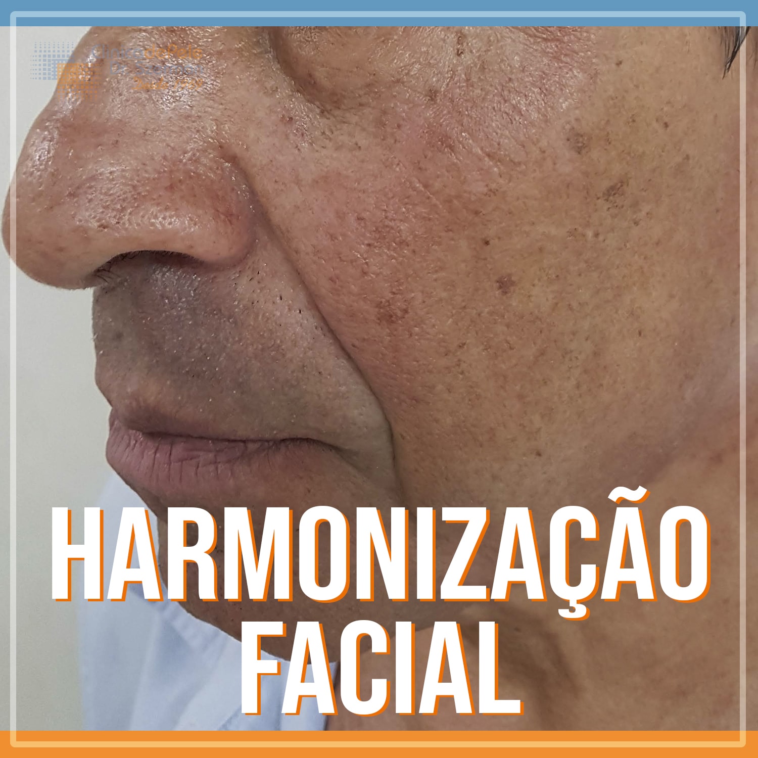 procedimento de harmonização facial