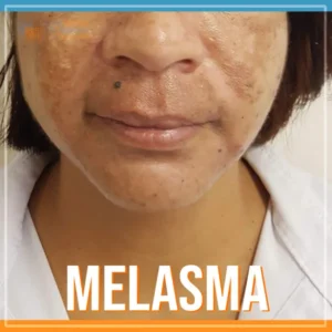 Clínica de Pele | Dermatologia, Laser & Estética | Como tirar melasma do rosto de forma rápida