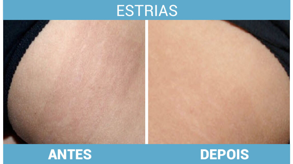 estrias tratamento