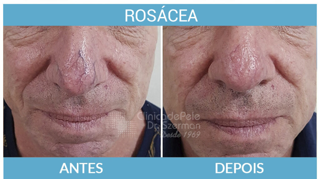 Rosácea Tratamento