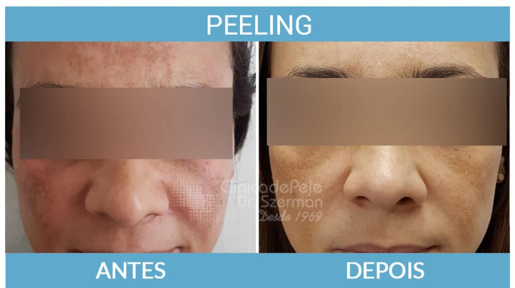 PEELING FACIAL