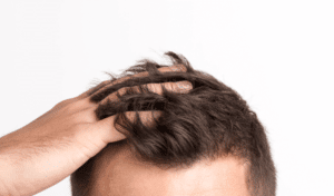 Clínica de Pele | Dermatologia, Laser & Estética | Laser Capilar: Entenda como funciona contra a queda de cabelo