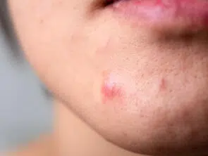 mitos e verdades sobre acne