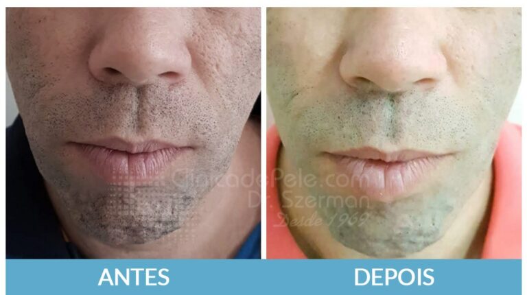 foto antes e depois de cicatrizes de acne