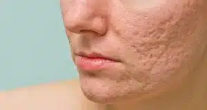 Redução de cicatrizes de acne