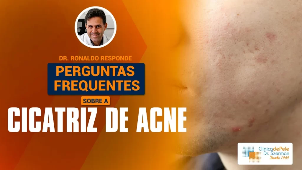 cicatriz acne
