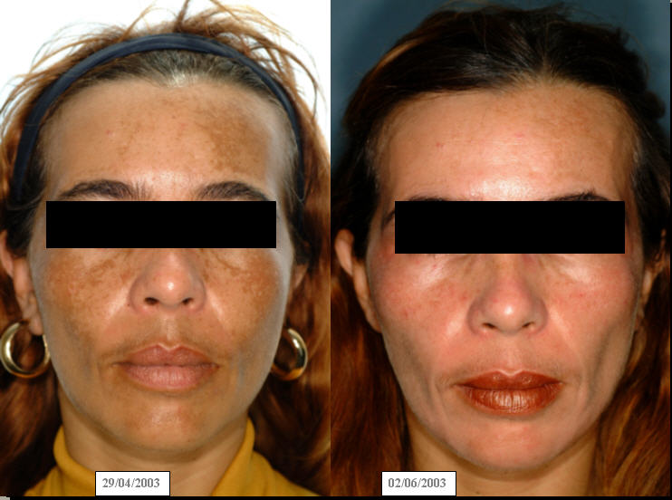 Peeling para manchas