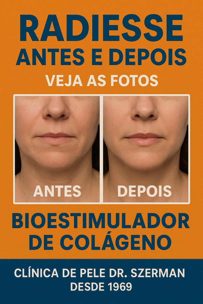 radiesse antes e depois - veja as fotos