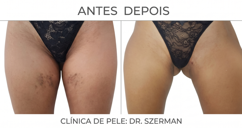 Manchas na Pele - Veja o Antes e Depois dos Tratamentos Mais Eficazes 18 Antes e depois de clareamento de manchas na virilha