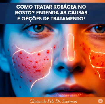 COMO TRATAR ROSÁCEA NO ROSTO