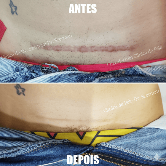 laser co2 cicatriz abdominoplastia 1