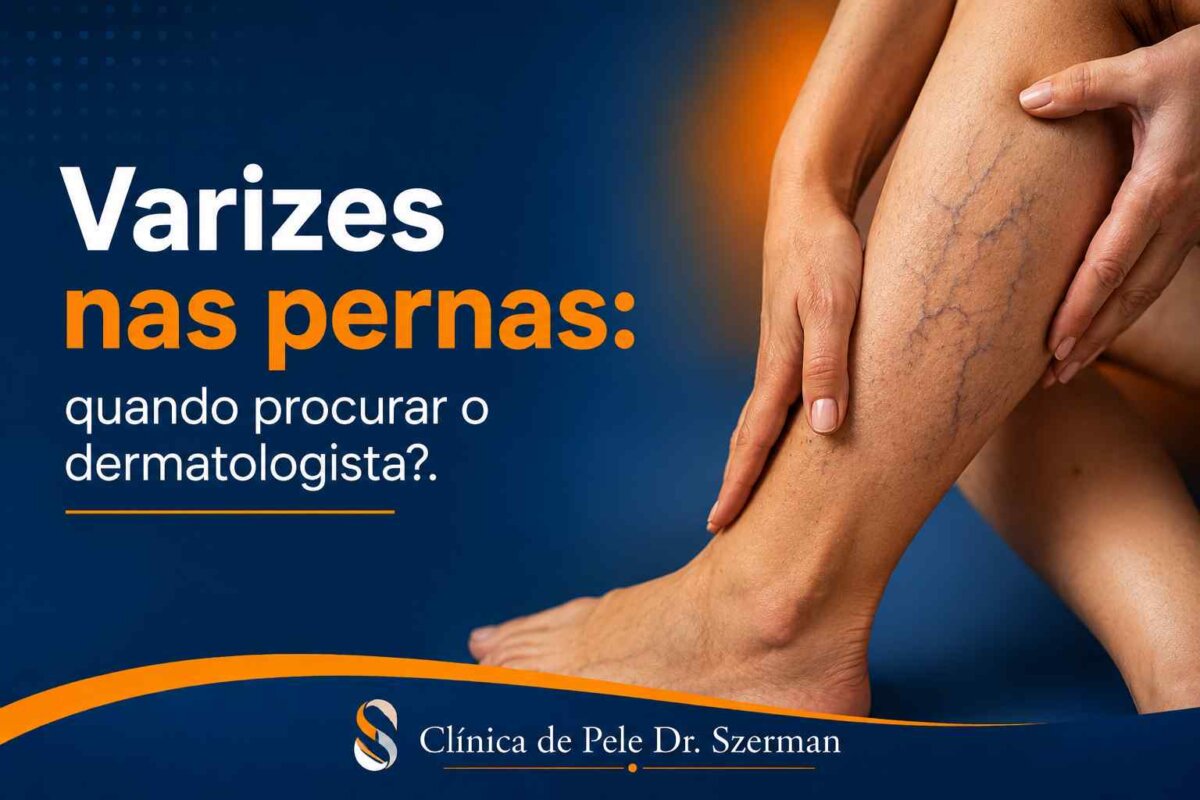 varizes nas pernas