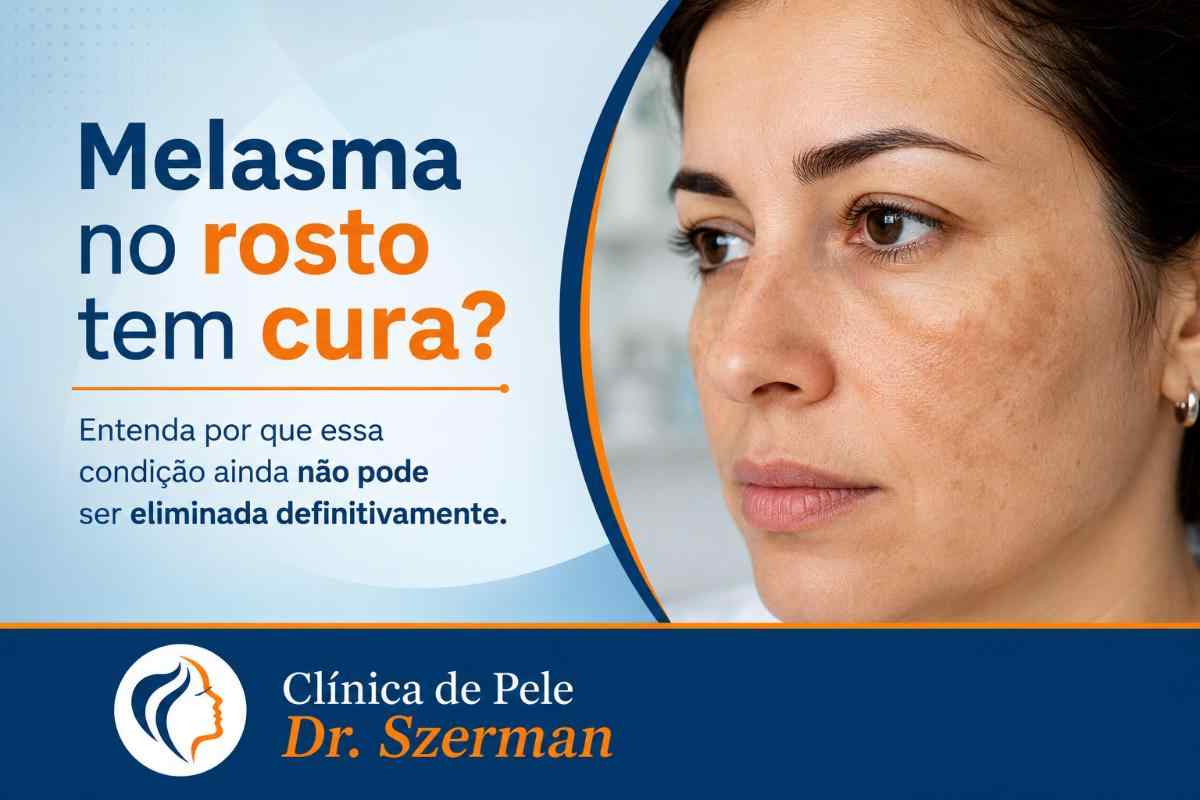 Melasma no rosto tem cura (